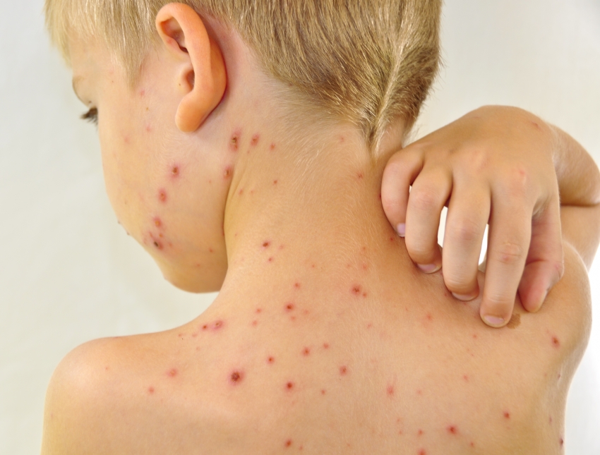 Epidemija boginja prijeti i Crnoj Gori