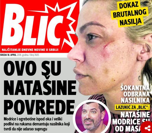 FOTO &#8211; Ovako izgleda Nataša Bekvalac nakon što je muž istukao