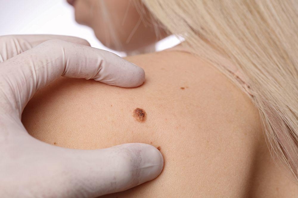 Besplatni dermatološki pregledi, bez zakazivanja, u šest crnogorskih gradova