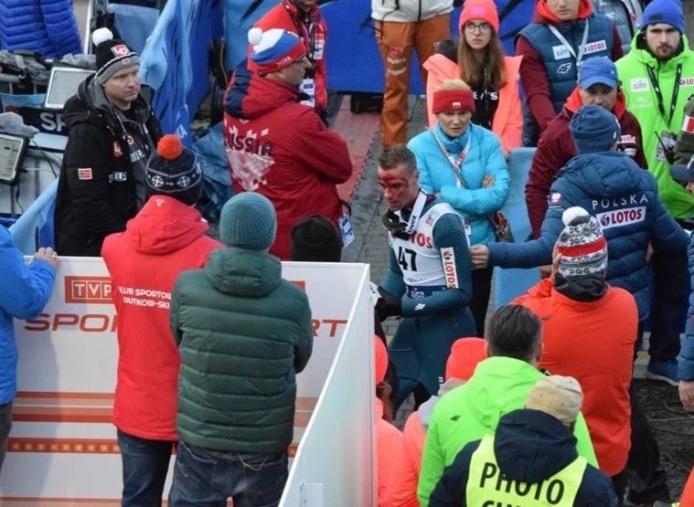 Poljski ski-skakač doživio stravičan pad na glavu, krvav napustio skakaonicu