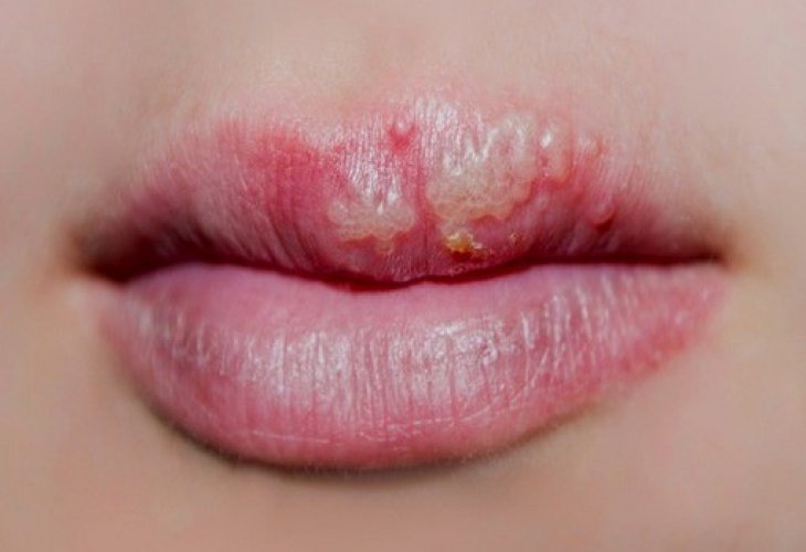 Da li herpes na usni može da bude znak korone?