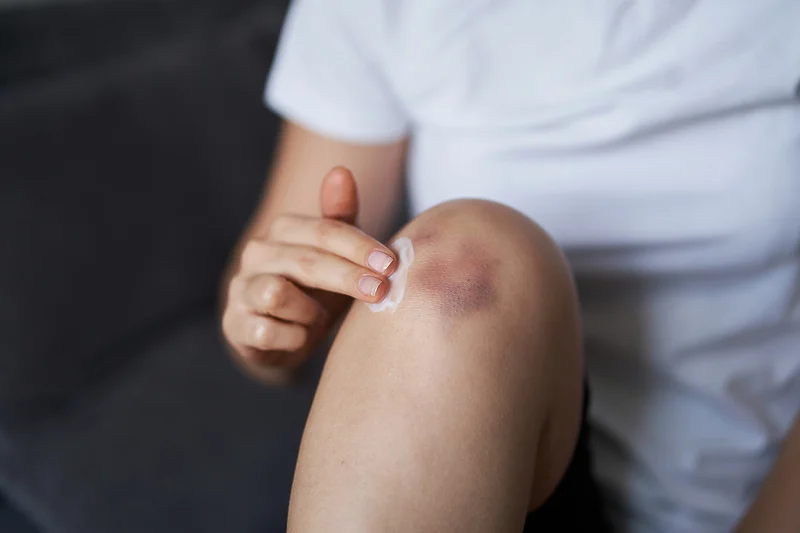 Često imate modrice? Ovo su mogući razlozi zašto se najednom pojave