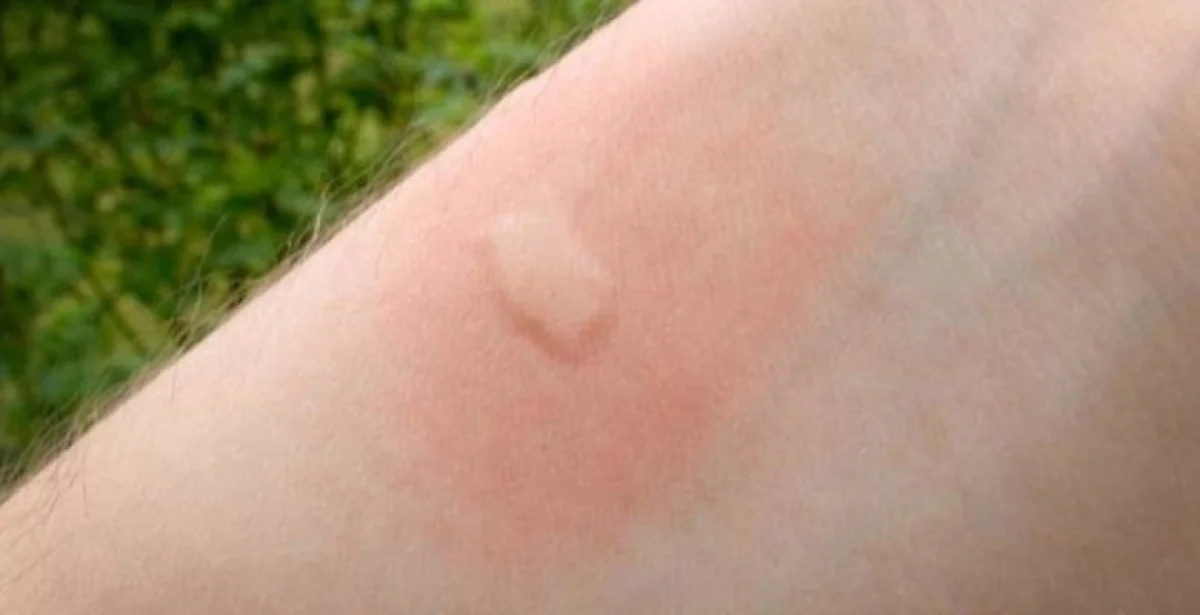 Šta treba da uradimo ako nas ubode insekt? Jedno svi prvo učinimo, a najopasnije je!